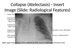 Collapse (Atelectasis) - Insert
Image (Slide: Radiological Features)
• Please insert a chest X-ray image showing lobar collapse here.
Recommended open-access images (download & insert):
1) Atelectasia1.jpg — Wikimedia Commons (Valencian Institute of Oncology):
https://commons.wikimedia.org/wiki/File:Atelectasia1.jpg
2) Atelectasis.png — Wikimedia Commons (CC BY-SA 4.0):
https://commons.wikimedia.org/wiki/File:Atelectasis.png
Suggested caption: 'Right upper lobe collapse with mediastinal shift towards the lesion. Source: Wikimedia
Commons (CC).'
After inserting the image, add interpretation: e.g., 'Volume loss, fissure displacement, mediastinal shift —
consistent with lobar collapse.'
Right upper lobe collapse with mediastinal shift. Source: Wikimedia Commons (CC).
 