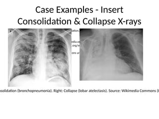 Case Examples - Insert
Consolidation & Collapse X-rays
• Insert two images side-by-side: (left) consolidation, (right) collapse.
Recommended images:
Left (consolidation): https://commons.wikimedia.org/wiki/File:X-ray_of_bronchopneumonia.png
Right (collapse): https://commons.wikimedia.org/wiki/File:Atelectasia1.jpg
Add boxed labels and brief bullet interpretations underneath each image.
nsolidation (bronchopneumonia). Right: Collapse (lobar atelectasis). Source: Wikimedia Commons (C
 