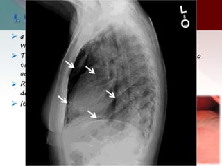  a sub-pleural collection of air within the layers of
visceral pleura caused by a ruptured alveolus.
 The air dissects through the interstitial tissue into
the thin, fibrous layer of visceral pleura where it
accumulates to form a bleb.
 Rupture of a bleb is often associated with the
development of a spontaneous pneumothorax.
 It is usually less than 1 cm in diameter.
 
