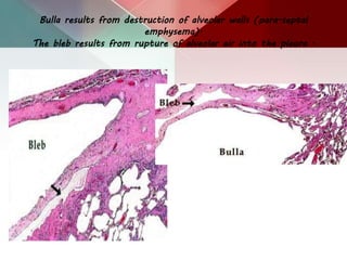 Bulla results from destruction of alveolar walls (para-septal
emphysema).
The bleb results from rupture of alveolar air into the pleura .
 
