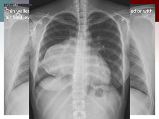 Thin walled spherical unilocular masses –fluid filled, air filled or with
air fluid levels
 