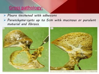 Gross pathology:
 Pleura thickened with adhesions
 Parenchyma-cysts up to 5cm with mucinous or purulent
material and fibrosis.
 