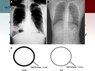  Pulmonary cavities are gas-filled areas of the
lung in the center of a nodule, mass, or area of
consolidation.
 They are usually evident on plain radiography and
CT.
 They are typically thick walled and their walls
must be greater than 2-5 mm.
 They may be filled with air as well as fluid and
may also demonstrate air-fluid levels.
 