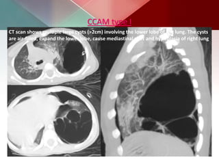 CCAM type I
CT scan shows multiple large cysts (>2cm) involving the lower lobe of left lung. The cysts
are air-filled, expand the lower lobe, cause mediastinal shift and hypoplasia of right lung
 