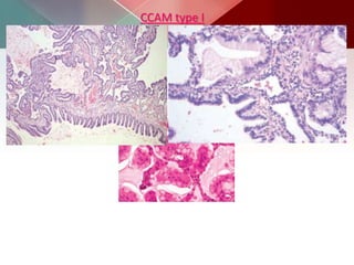 CCAM type I
 