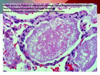 Alveoli which are distended with honey- combed, foamy, brightly eosinophilic material .
There is a scanty inflammatory infiltrate composed
mainly of monocyte, occasional plasma cells and histiocytes.
 