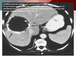 Calcified unilocular hydatid cyst. Contrast material enhanced
CT scan shows a round lesion with water attenuation and a ring like pattern of
calcification (arrows). This pattern represents calcification of the peri-cyst and
strongly suggests a diagnosis of hydatid cyst
 