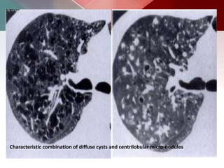 Characteristic combination of diffuse cysts and centrilobular micro-nodules
 