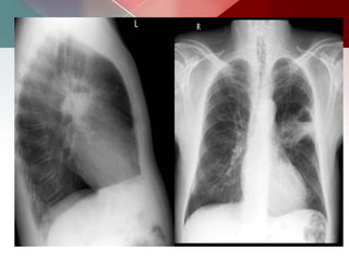 Lung cysts &amp; cavities