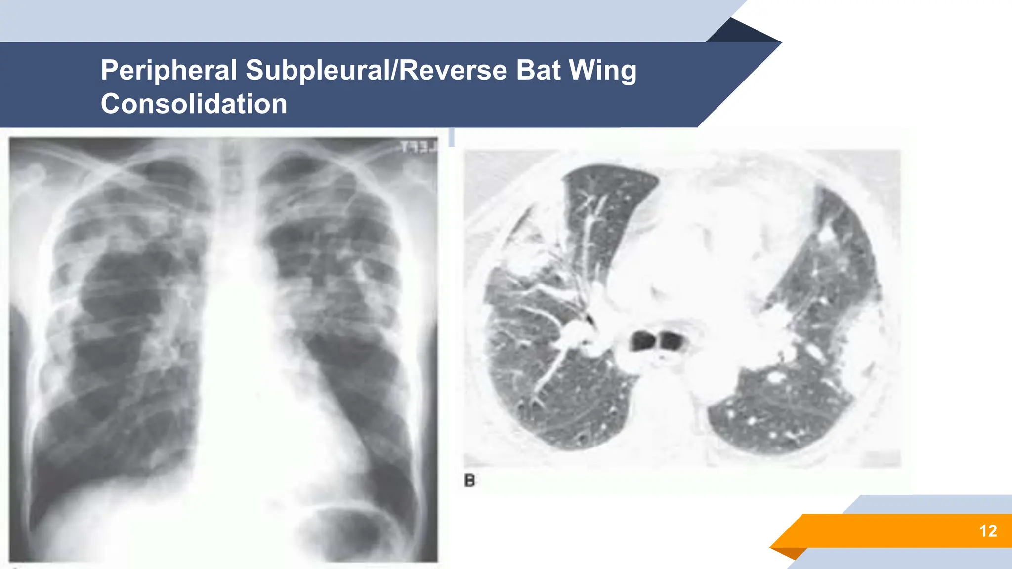 Imaging /radiographic findings of Lung Densities.pptx