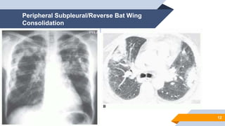 Imaging /radiographic findings of Lung Densities.pptx
