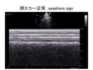 Lung echo for slideshare | PPT