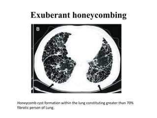 Exuberant honeycombing
Honeycomb cyst formation within the lung constituting greater than 70%
fibrotic person of Lung.
 