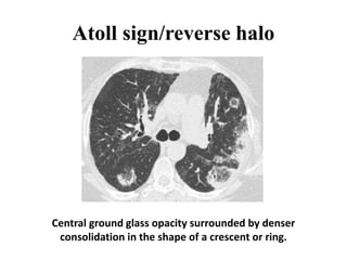 Atoll sign/reverse halo
Central ground glass opacity surrounded by denser
consolidation in the shape of a crescent or ring.
 