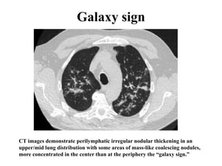 Galaxy sign
CT images demonstrate perilymphatic irregular nodular thickening in an
upper/mid lung distribution with some areas of mass-like coalescing nodules,
more concentrated in the center than at the periphery the “galaxy sign.”
 