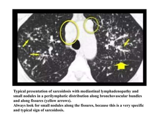 Typical presentation of sarcoidosis with mediastinal lymphadenopathy and
small nodules in a perilymphatic distribution along bronchovascular bundles
and along fissures (yellow arrows).
Always look for small nodules along the fissures, because this is a very specific
and typical sign of sarcoidosis.
 