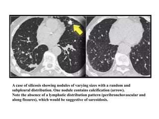 A case of silicosis showing nodules of varying sizes with a random and
subpleural distribution. One nodule contains calcification (arrow).
Note the absence of a lymphatic distribution pattern (peribronchovascular and
along fissures), which would be suggestive of sarcoidosis.
 