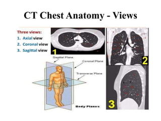 CT Chest Anatomy - Views
 