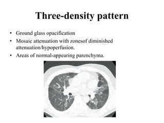 Three-density pattern
• Ground glass opacification
• Mosaic attenuation with zonesof diminished
attenuation/hypoperfusion.
• Areas of normal-appearing parenchyma.
 