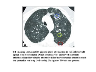 CT imaging shows patchy ground-glass attenuation in the anterior left
upper lobe (blue circle). Other lobules are of preserved (normal)
attenuation (yellow circle), and there is lobular decreased attenuation in
the posterior left lung (red circle). No signs of fibrosis are present
 
