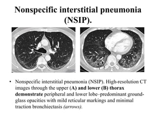 Nonspecific interstitial pneumonia
(NSIP).
• Nonspecific interstitial pneumonia (NSIP). High-resolution CT
images through the upper (A) and lower (B) thorax
demonstrate peripheral and lower lobe–predominant ground-
glass opacities with mild reticular markings and minimal
traction bronchiectasis (arrows).
 