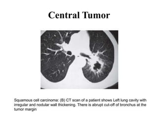 Central Tumor
 
