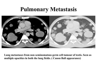 Pulmonary Metastasis
Lung metastases from non seminomatous germ cell tumour of testis. Seen as
multiple opacities in both the lung fields. ( Canon Ball appearance)
 