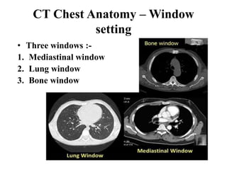 CT Chest Anatomy – Window
setting
• Three windows :-
1. Mediastinal window
2. Lung window
3. Bone window
 