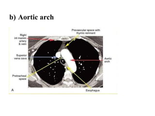 b) Aortic arch
 