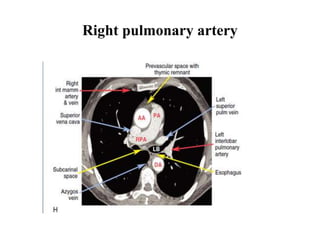 Right pulmonary artery
 