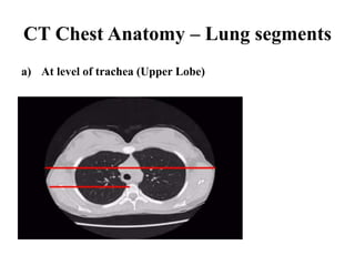 CT Chest Anatomy – Lung segments
a) At level of trachea (Upper Lobe)
 