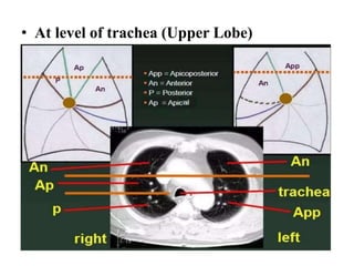 • At level of trachea (Upper Lobe)
 