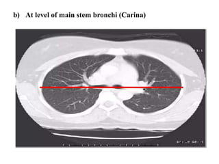 b) At level of main stem bronchi (Carina)
 