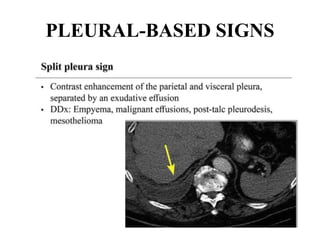 PLEURAL-BASED SIGNS
 