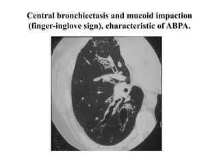 Central bronchiectasis and mucoid impaction
(finger-inglove sign), characteristic of ABPA.
 