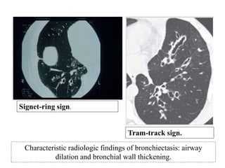 Signet-ring sign.
Tram-track sign.
Characteristic radiologic findings of bronchiectasis: airway
dilation and bronchial wall thickening.
 