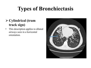 Types of Bronchiectasis
 Cylindrical (tram
track sign)
• This description applies to dilated
airways seen in a horizontal
orientation.
 