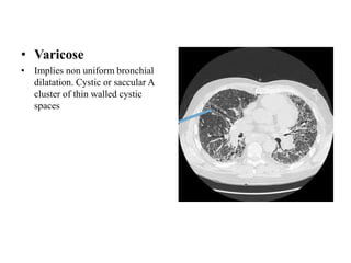 • Varicose
• Implies non uniform bronchial
dilatation. Cystic or saccular A
cluster of thin walled cystic
spaces
 