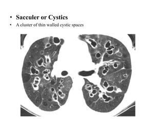 • Sacculer or Cystics
• A cluster of thin walled cystic spaces
 
