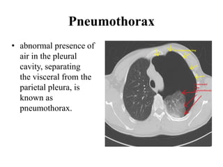 Pneumothorax
• abnormal presence of
air in the pleural
cavity, separating
the visceral from the
parietal pleura, is
known as
pneumothorax.
 