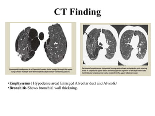 CT Finding
•Emphysema ( Hypodense area) Enlarged Alveolar duct and Alveoli.
•Bronchitis Shows bronchial wall thickning.
 