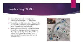 Positioning Of DLT
 Auscultation alone is unreliable for
confirmation of proper DLT placement.
 Auscultation and bronchoscopy should both
be used each time a DLT is placed and again
when the patient is repositioned.
 Fiberoptic bronchoscopy is performed first
through the tracheal lumen to ensure that
the endobronchial portion of the DLT is in
the left bronchus and that there is no
bronchial cuff herniation over the carina
after inflation.
 