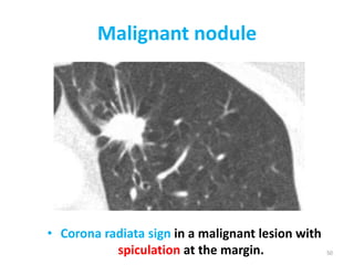 Spiculation Sign IMAGING IN LUNG CANCER | PPTX