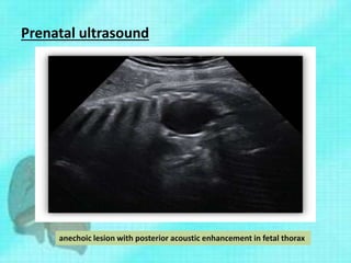 Prenatal ultrasound
anechoic lesion with posterior acoustic enhancement in fetal thorax
 