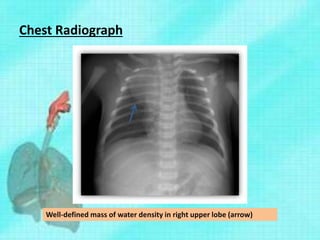 Chest Radiograph
Well-defined mass of water density in right upper lobe (arrow)
 