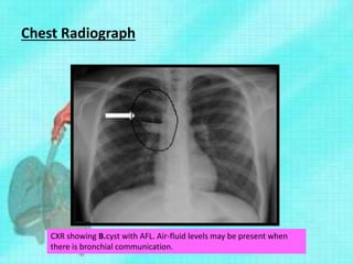 Chest Radiograph
CXR showing B.cyst with AFL. Air-fluid levels may be present when
there is bronchial communication.
 