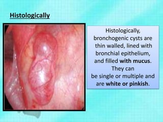 Histologically
Histologically,
bronchogenic cysts are
thin walled, lined with
bronchial epithelium,
and filled with mucus.
They can
be single or multiple and
are white or pinkish.
 