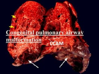 Congenital pulmonary airway
malformation
CCAM
 