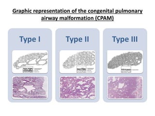 Graphic representation of the congenital pulmonary
airway malformation (CPAM)
 