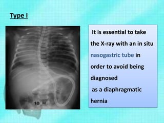 Type I
It is essential to take
the X-ray with an in situ
nasogastric tube in
order to avoid being
diagnosed
as a diaphragmatic
hernia
 